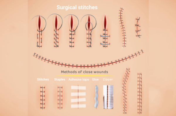 Adhesive tape, stitches, staples, zipper, glue: How to choose ...