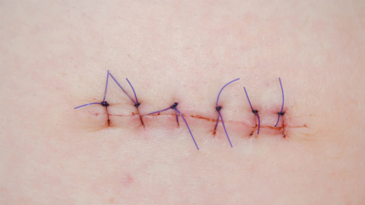 staples versus sutures